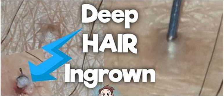 Ingrown hair longest